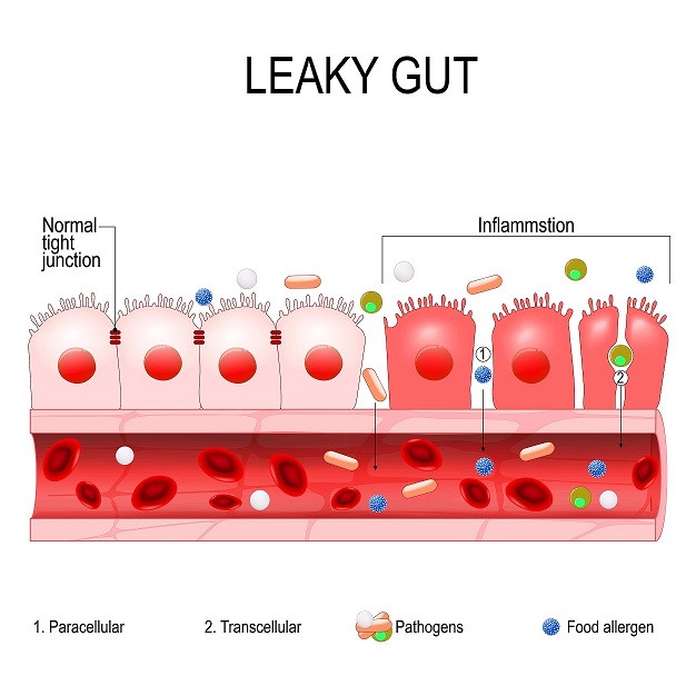 What Causes Autoimmune Disease?