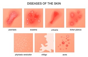 Cod liver oil for acne cure - Does it Work?