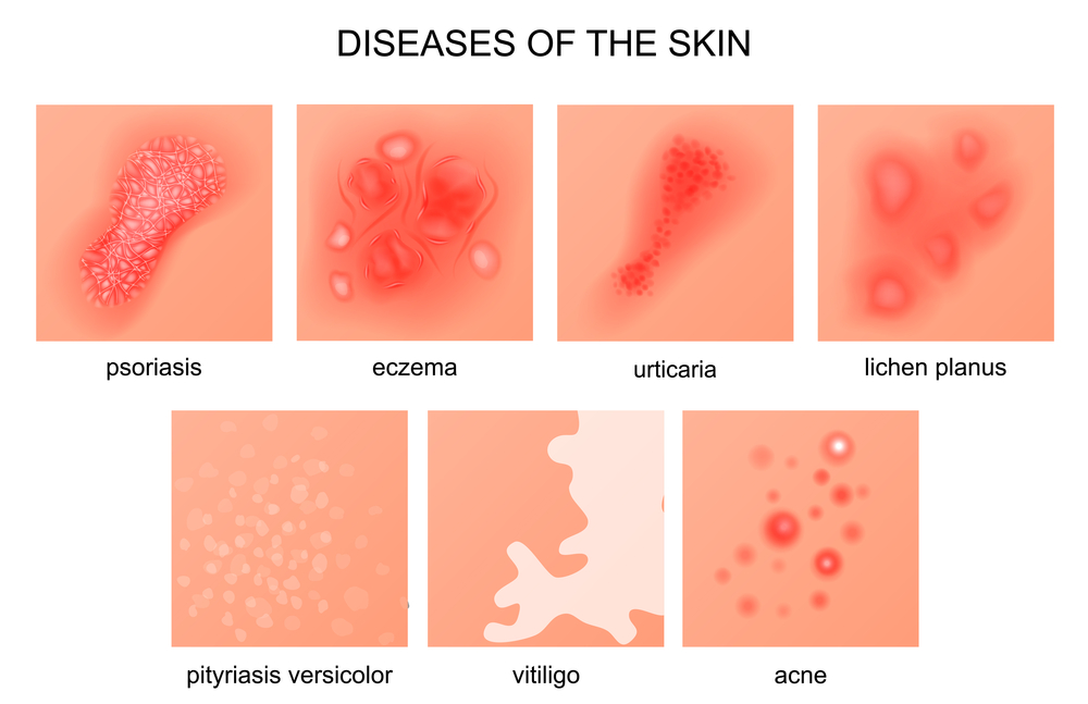 Skin diseases - Is eczema a gut problem?